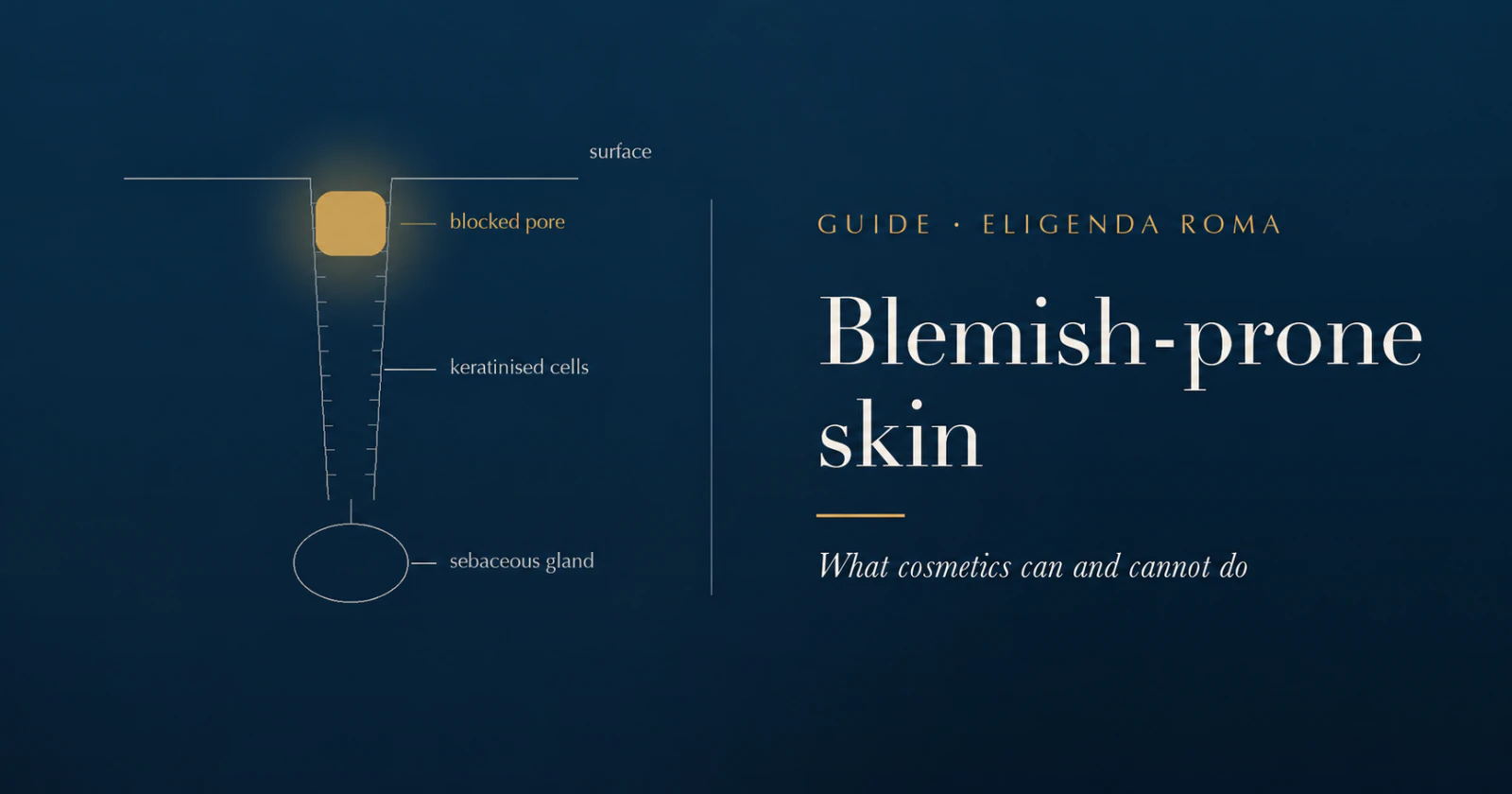 Blemish-prone skin: a diagram of a blocked pore, keratinised cells and the sebaceous gland.