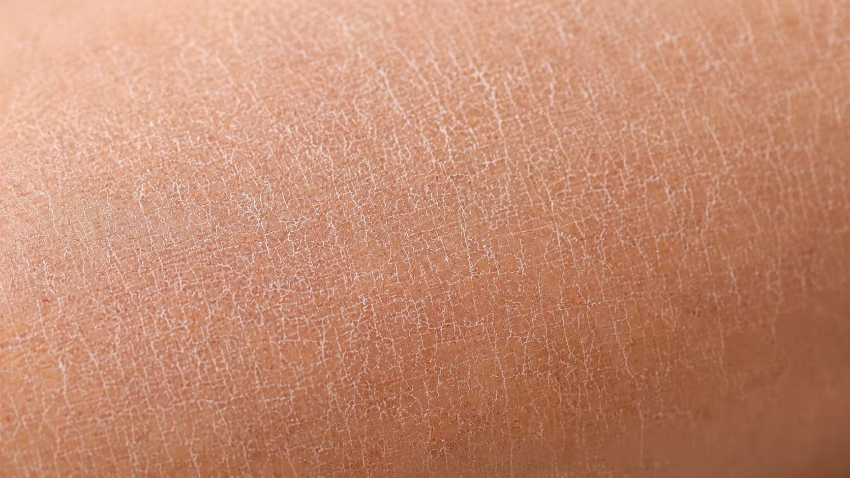 Pelle disidratata in primo piano: la texture screpolata dovuta allo stress estivo